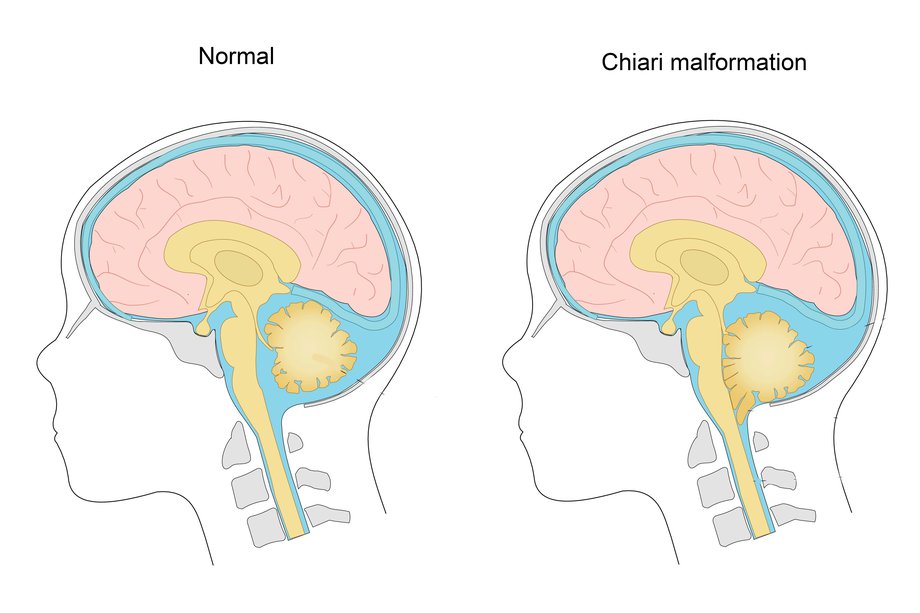 Diagram showing a Chiari malformation