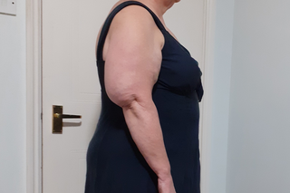 Side view of a person with an enlarged upper arm