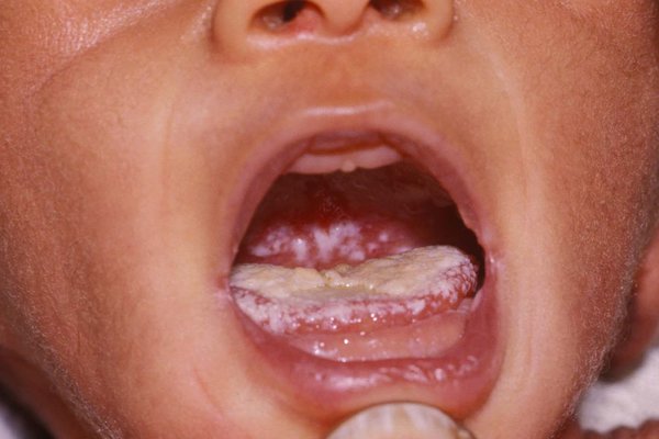 A white coating on the tongue like cottage cheese – this can't be rubbed off easily. Image Credit: DR M.A. ANSARY/SCIENCE PHOTO LIBRARY