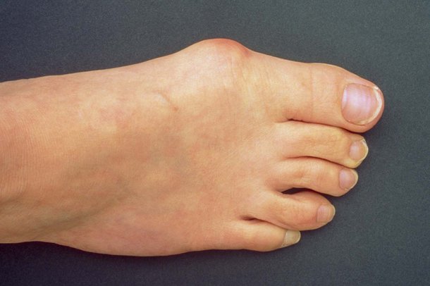 Foot pain - NHS.UK