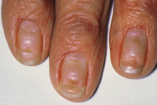 Fingernails with deep lines or grooves across them
