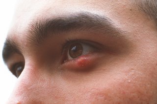 eye swelling reduce how NHS Stye