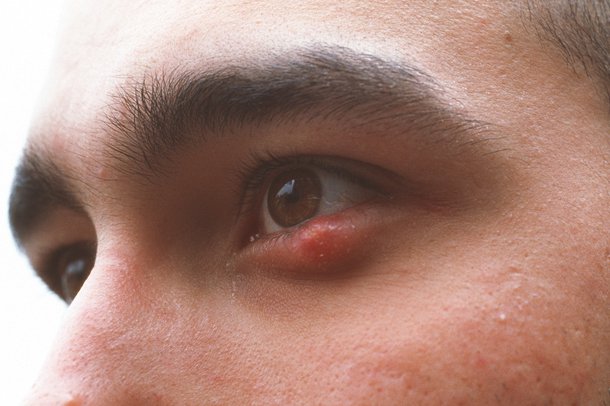 Stye on lower eyelid