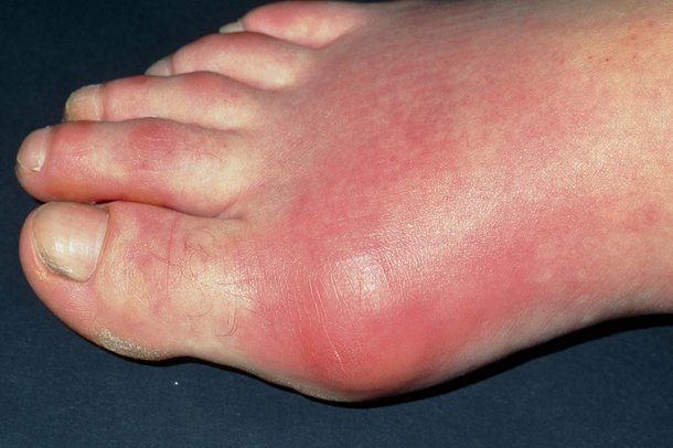A foot with gout