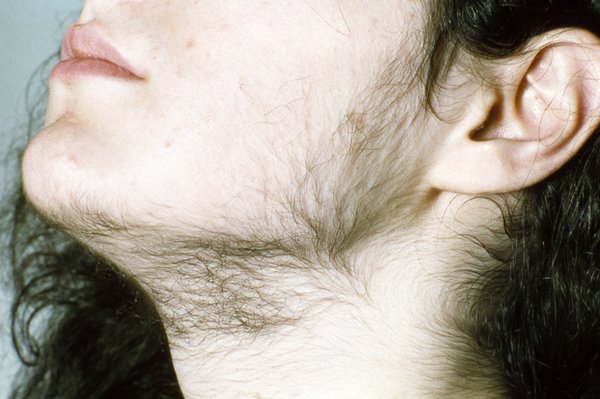 Picture of woman with hirsutism
