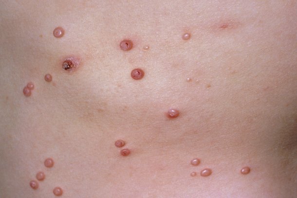 Molluscum contagiosum rash