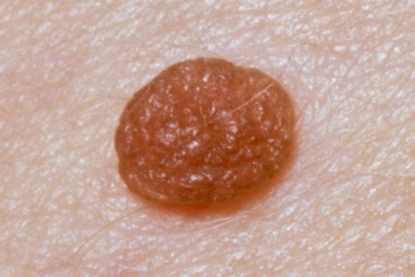 Most harmless moles are round or oval-shaped, with a smooth edge Image Credit: SCIENCE PHOTO LIBRARY