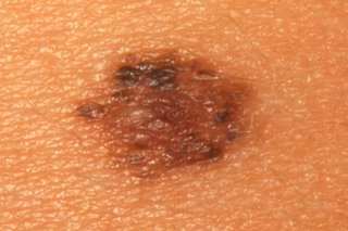 A harmless flat mole on the skin