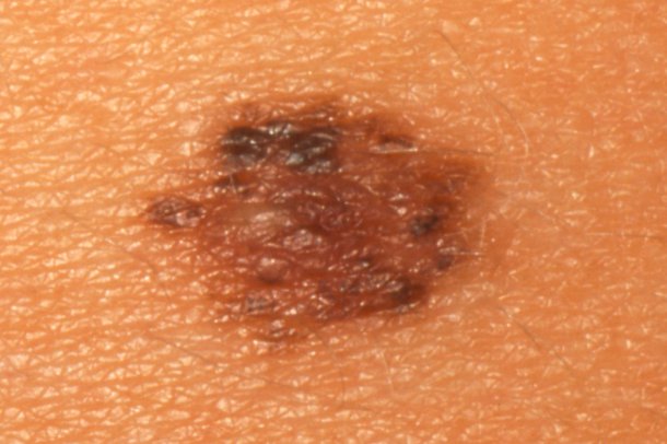 Moles NHS UK