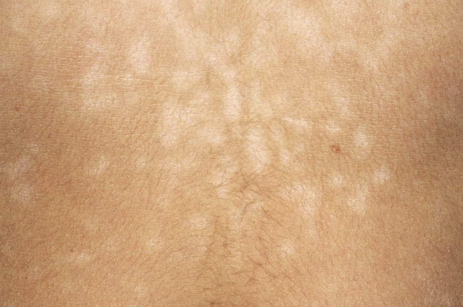 pityriasis-versicolor-what-is-it-symptoms-and-treatment-mediologiest