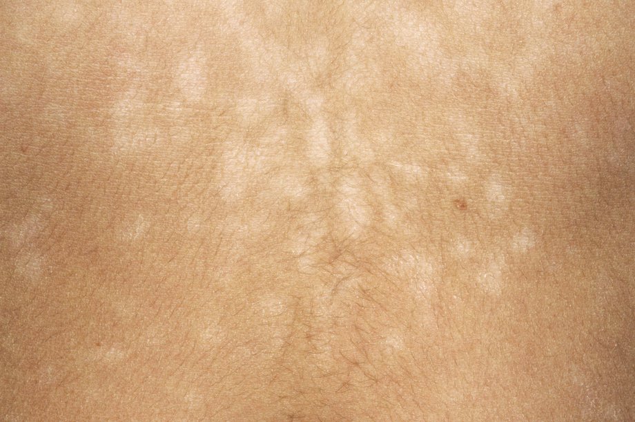 Pityriasis Versicolor What Is It Symptoms And Treatment Mediologiest