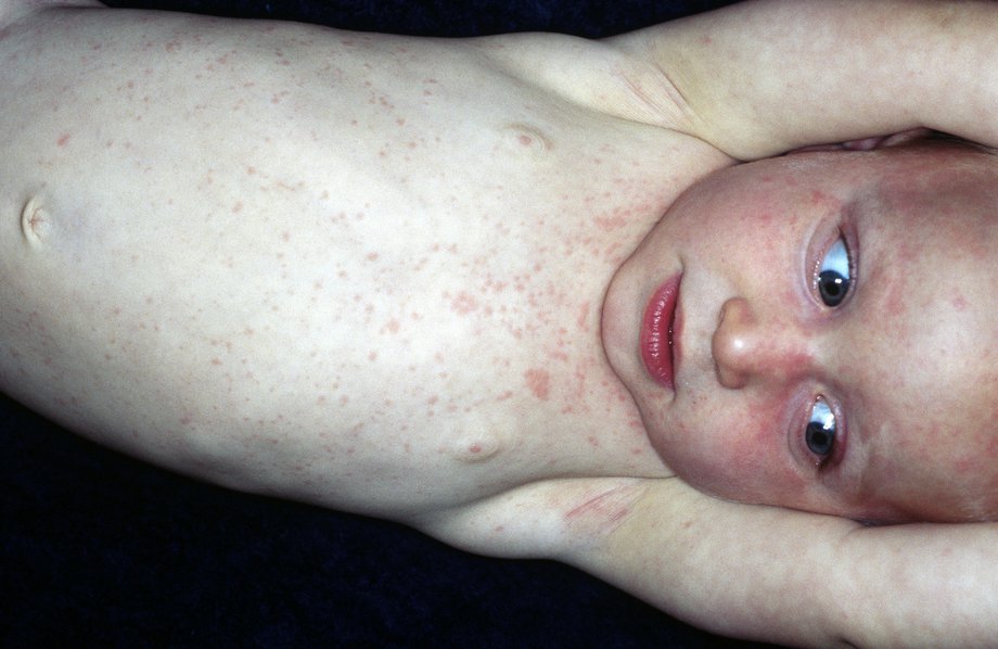 Picture of roseola rash