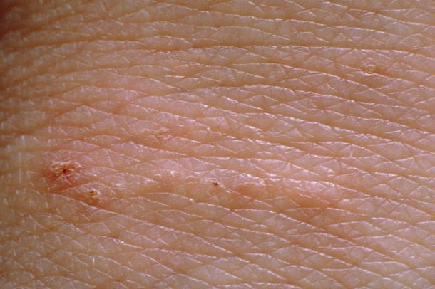 Silvery lines on a hand caused by scabies mites