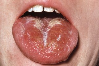 A red and swollen tongue with a white coating.