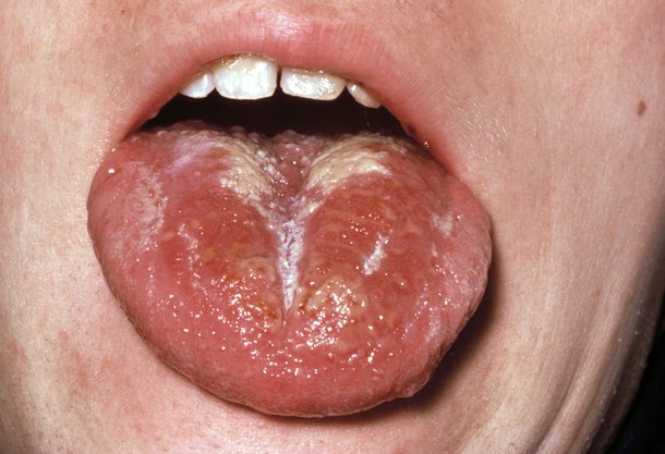 Picture of scarlet fever red or white tongue