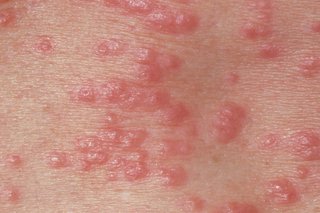 Red spots on the skin caused by scabies