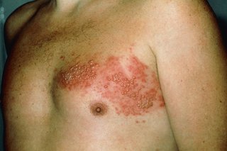 A red, blotchy rash in a band on one side of the body
