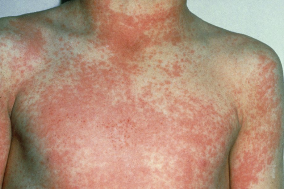 Scarlet fever rash on a child