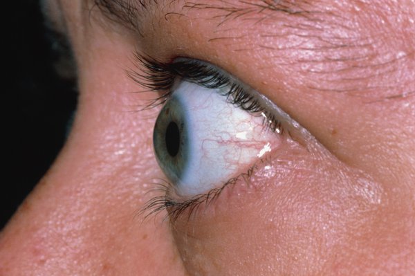 Picture of exophthalmos