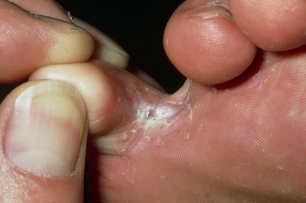 Treat Cracked Skin Between Toes