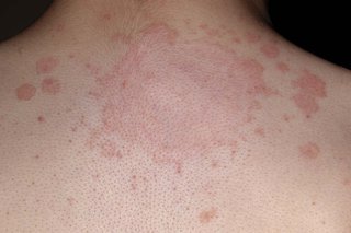 A large ringworm rash on the skin