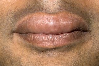 Picture of swollen lips caused by angioedema