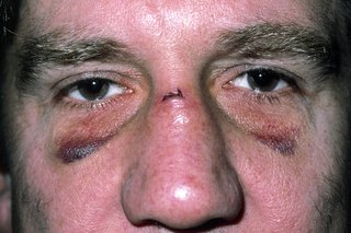 Seorang pria dengan dua mata hitam dan luka di hidungnya