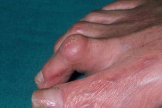 A foot with hammer toe