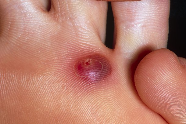 A red blister on the sole of a foot