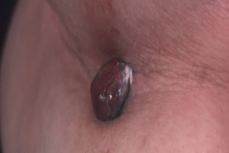 Picture of nodular melanoma