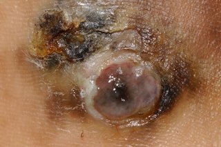 Gambar melanoma lentiginous acral.