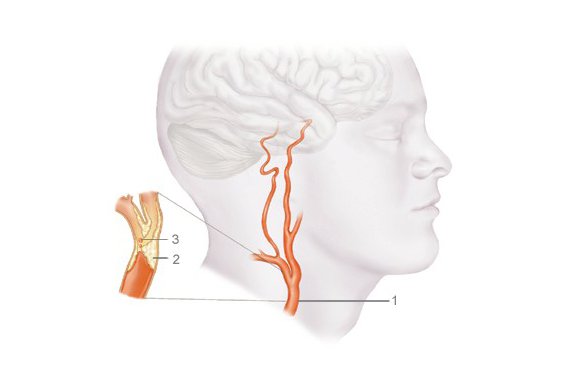 Picture of a blocked carotid artery