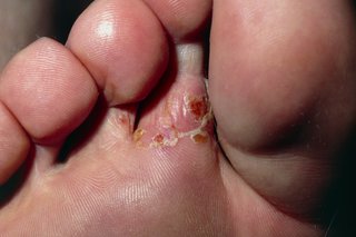white skin between toes