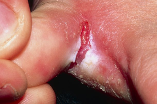 Cracked skin between toes caused by athlete's foot