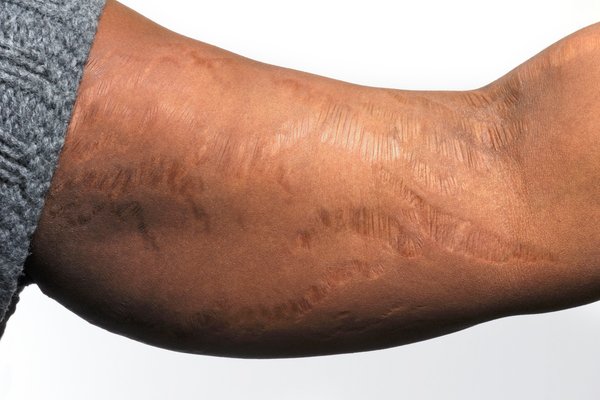 Upper arm with areas of stretched, shiny skin.
