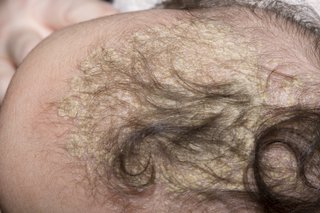 Image of cradle cap crusts on a baby's head