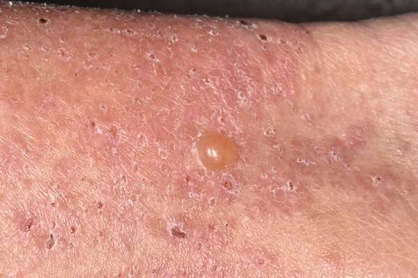 After a few weeks, small blisters may appear