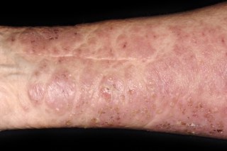 Large red, blotchy, dry rash with small scabs on the arm of a person with white skin