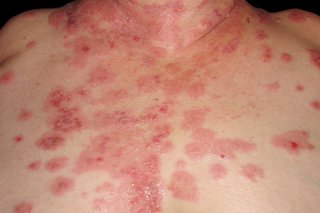 Lots of sore red patches with small blisters spread across white skin on a woman's chest.