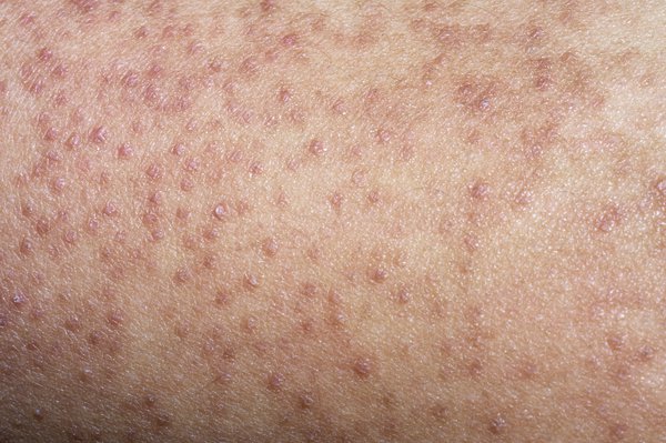 Painless small bumps on your skin