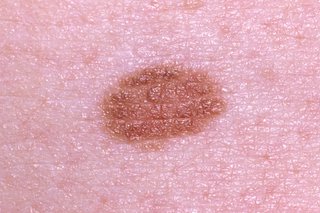 A harmless flat mole on the skin