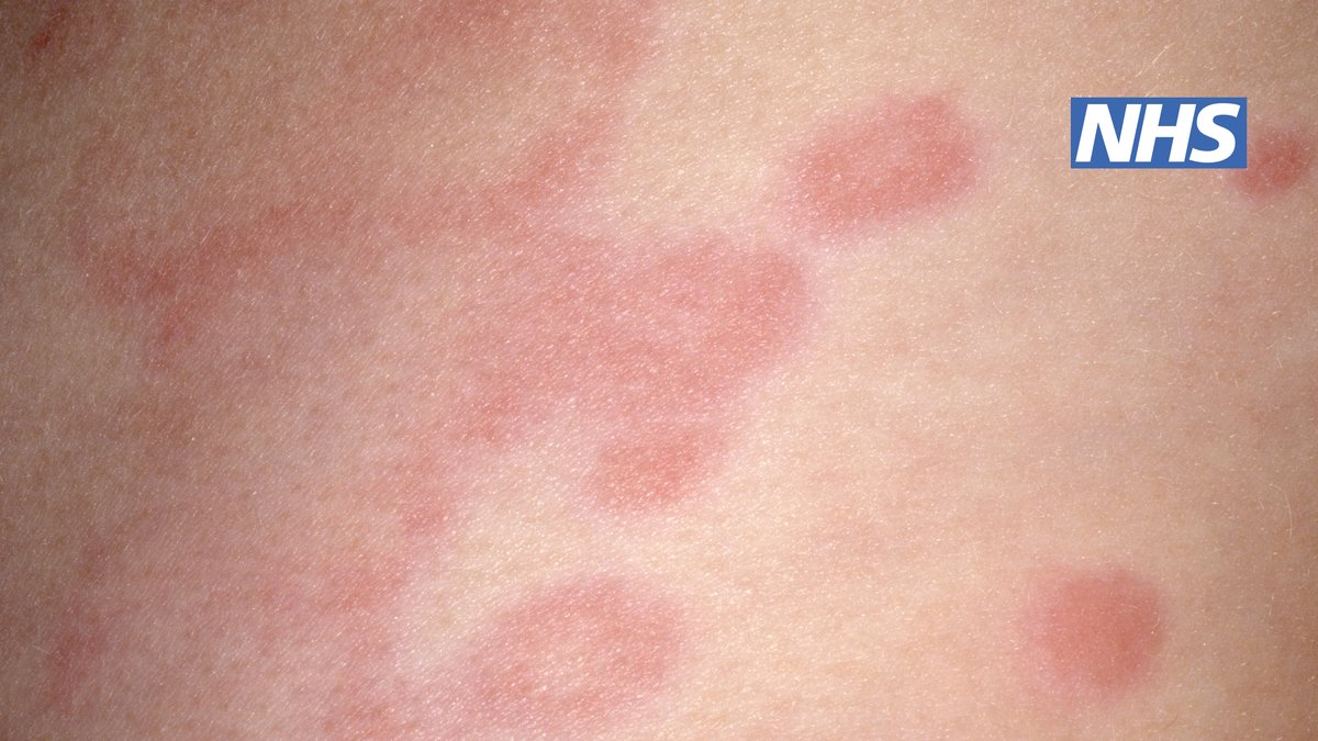 NHS Skin Rash Identification