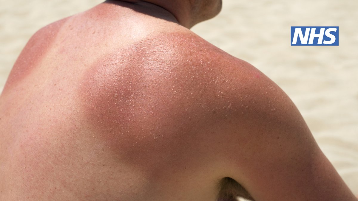 what can you put on a sunburn blister