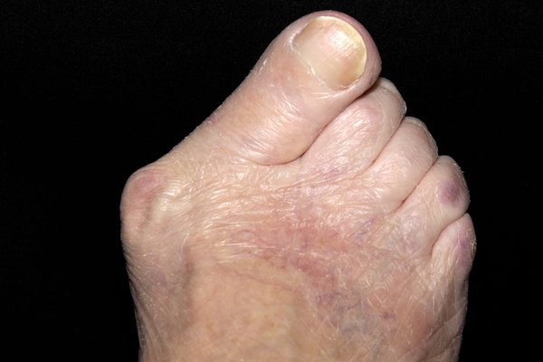 Your big toe pointing towards your other toes