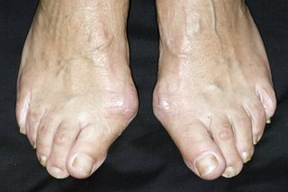 Bunions on both feet