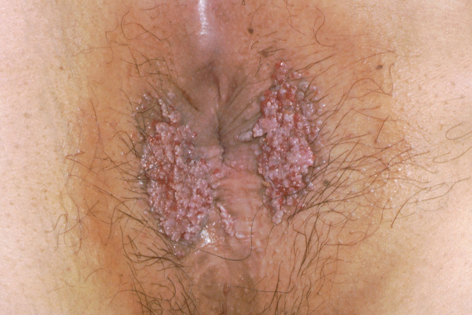 Warts on anus. 