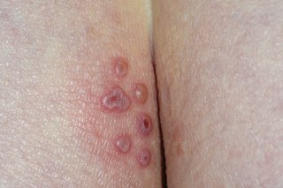 Herpes blaren en open zweren (zweren) op de billen