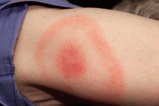 A classic bull's-eye Lyme disease rash on an arm