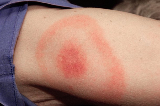 A classic bull's eye Lyme disease rash on an arm