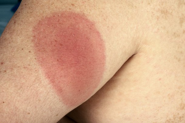 A red, circular Lyme disease rash on an arm